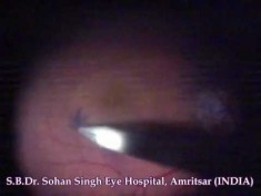 Macular Hole with ILM peeling